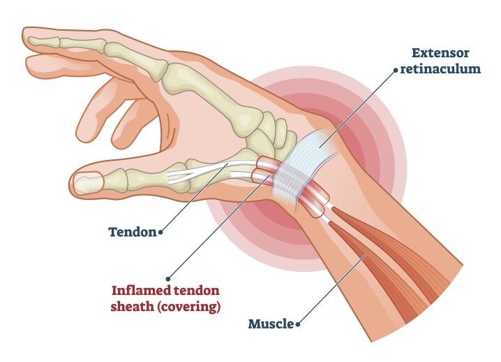 What is De Quervain’s Tenosynovitis?